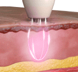 Tripolar Dermaplane